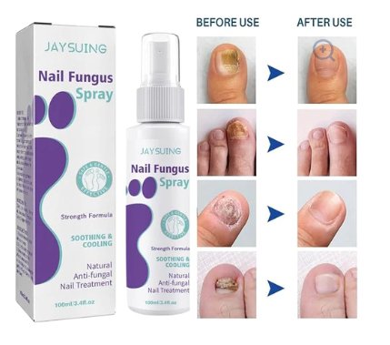 Gentle Nail Fungus Remover Maxum